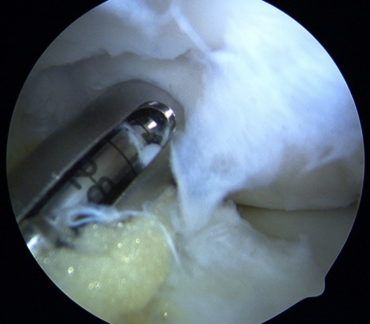 Mosaicplasty 4.5 mm dril